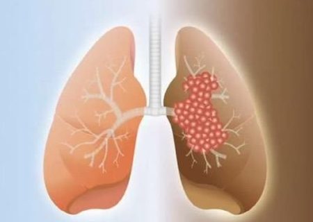 به‌کارگیری روش نوین برای تشخیص بیماری فیبروز ریه در بوشهر
