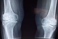 تشخیص علائم اولیه پوکی استخوان با هوش مصنوعی