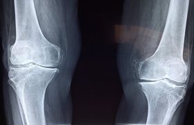 تشخیص علائم اولیه پوکی استخوان با هوش مصنوعی