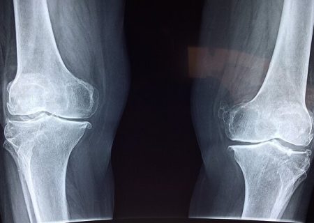 تشخیص علائم اولیه پوکی استخوان با هوش مصنوعی