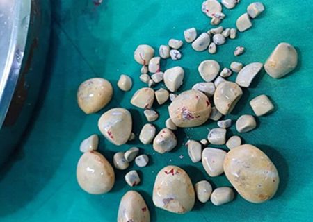 ۶۷ سنگ با ابعاد مختلف از مثانه بیمار در بیمارستان گناوه خارج شد