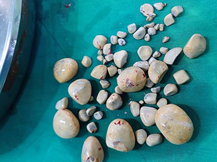 ۶۷ سنگ با ابعاد مختلف از مثانه بیمار در بیمارستان گناوه خارج شد