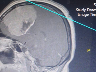 انجام عمل سخت و حساس تومور بزرگ مغزی در بیمارستان شهید صادق گنجی برازجان